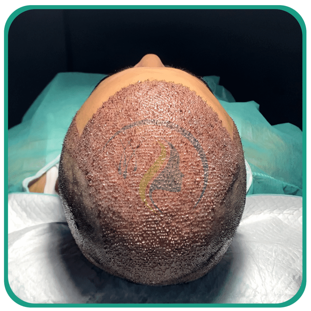 Hair Transplant in Peshawar