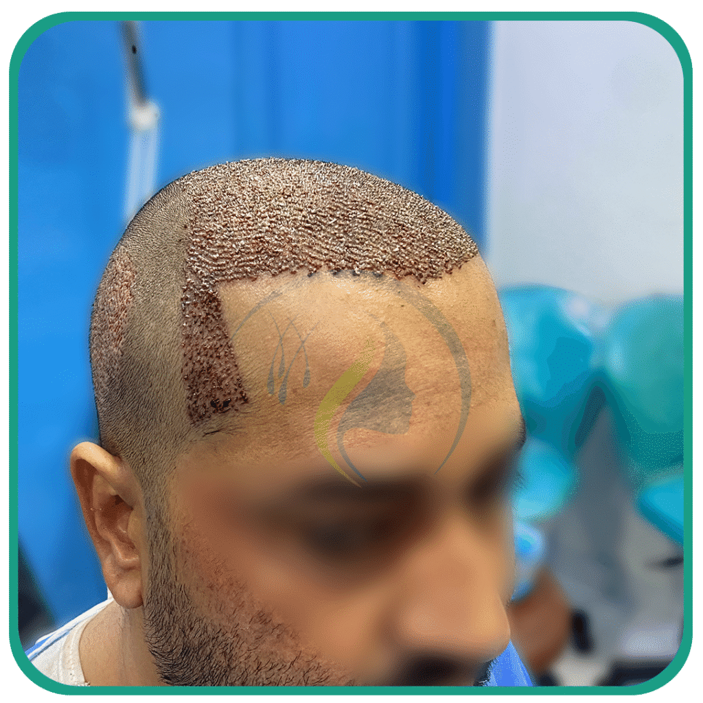 Hair Transplant in Peshawar