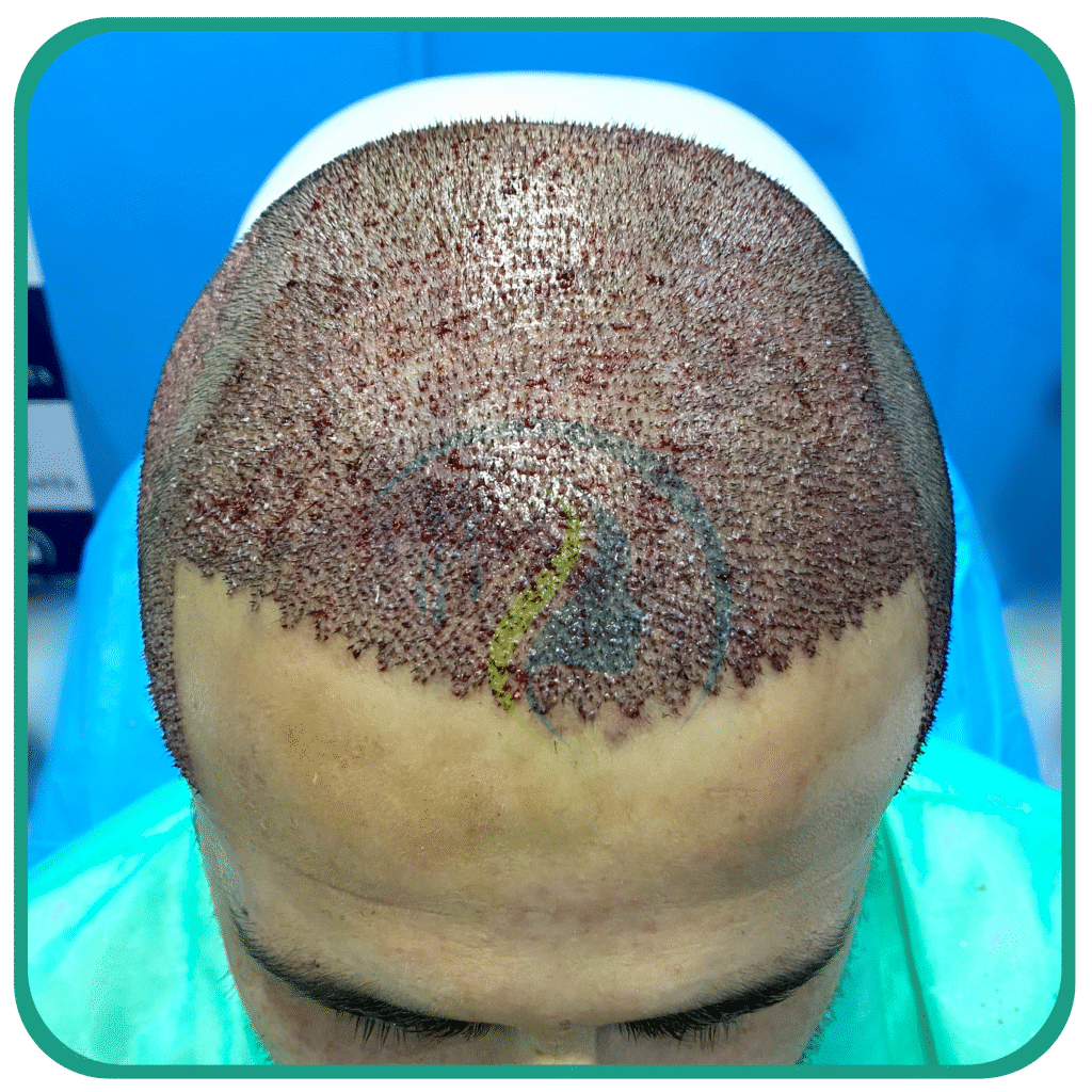 Hair Transplant in Peshawar