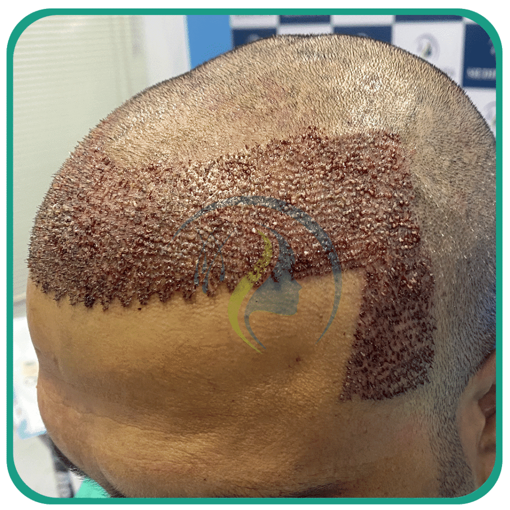 Hair Transplant in Peshawar