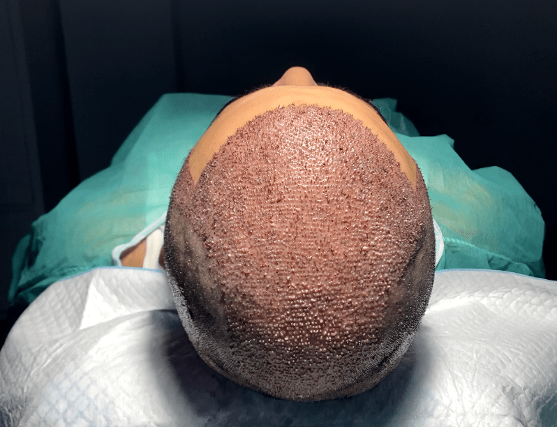 Hair transplant in Peshawar