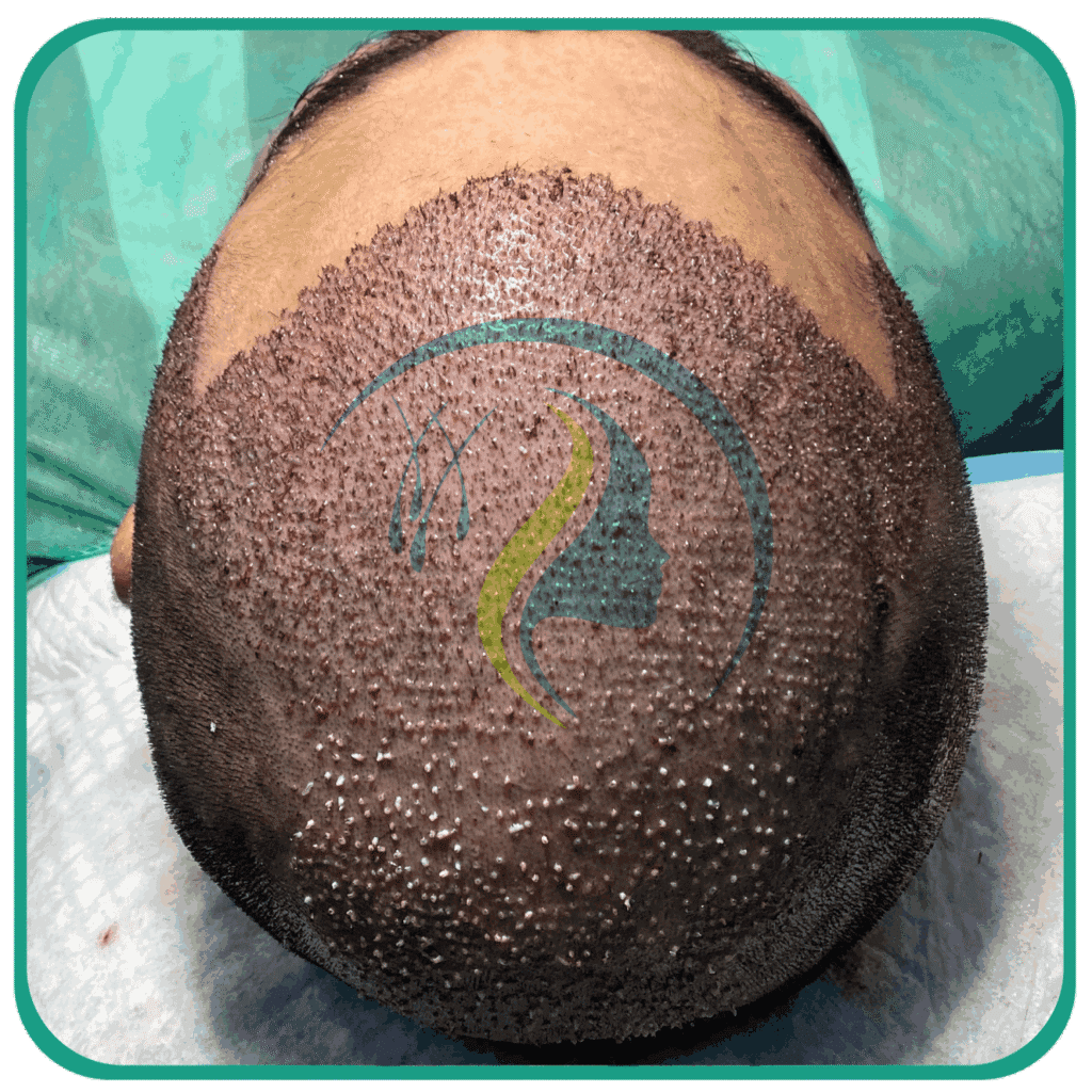 Hair Transplant in Peshawar
