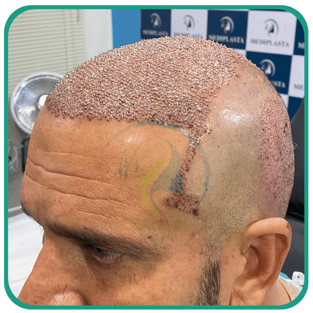 Hair Transplant in Peshawar