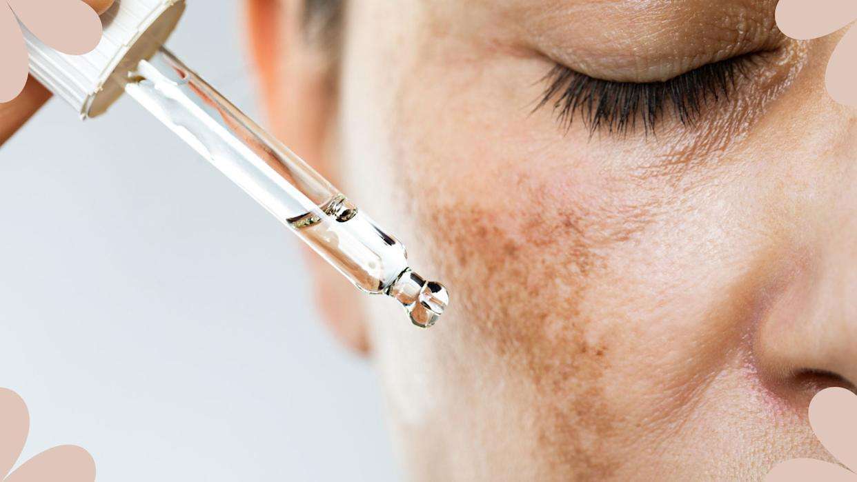 Melasma Treatment in peshawar